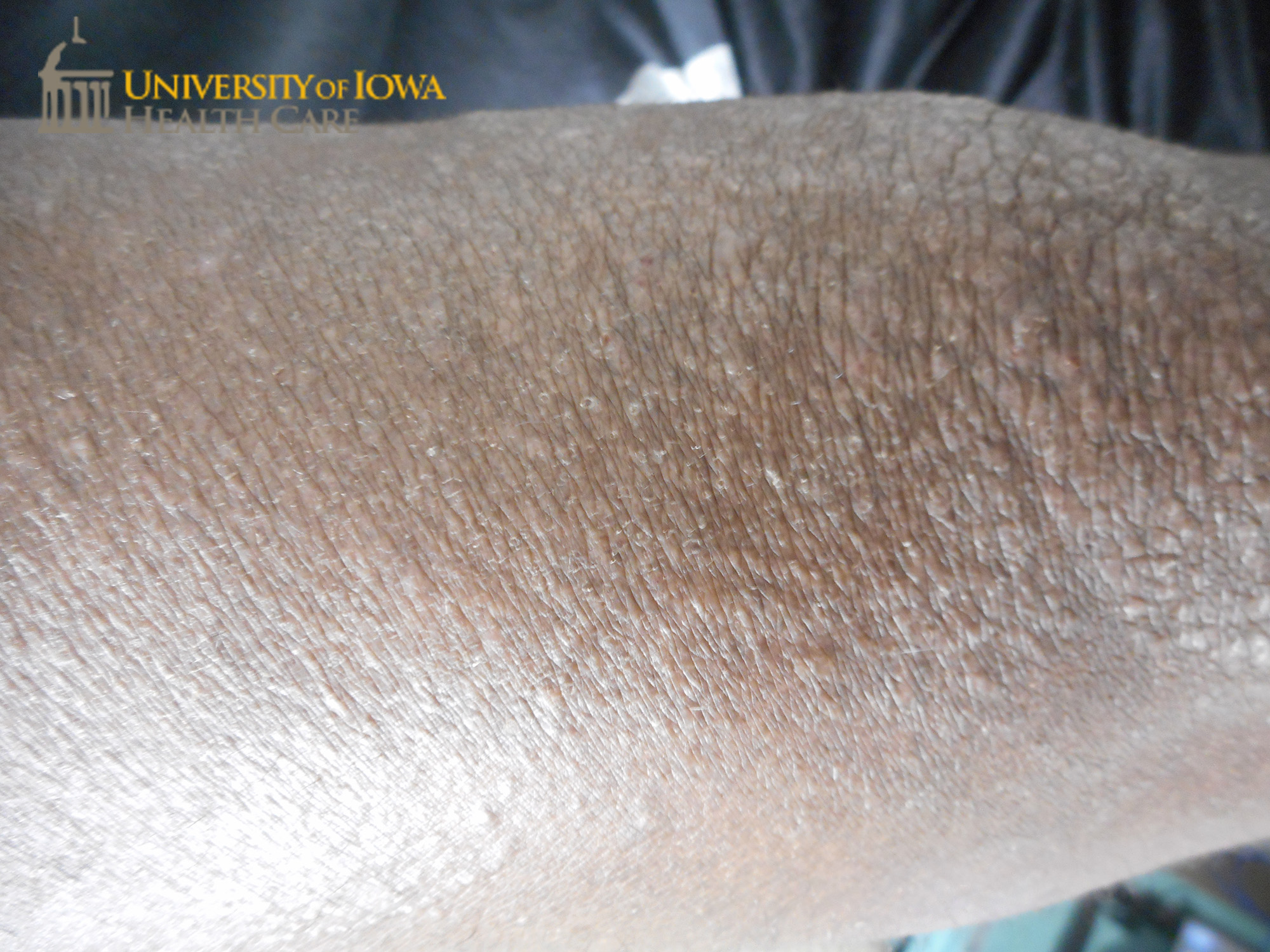 Pink waxy papules on the leg. (click images for higher resolution).